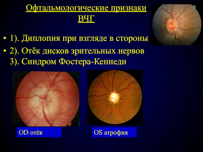 Признаки атрофии головного мозга. Офтальмоскопический синдром Фостера-Кеннеди. Атрофия диска зрительного нерва. Отечный диск зрительного нерва. Отек диска зрительного нерва.