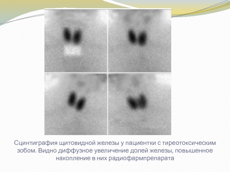 Сцинтиграфия щитовидной железы. Диффузный зоб сцинтиграфия. Повышенное накопление РФП щитовидной железы. Сцинтиграфия щитовидной железы с 99mtc-пертехнетатом у детей. Сцинтиграфия ЩЖ радиофармпрепаратами.