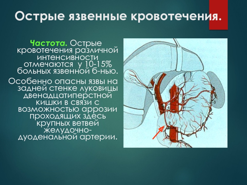 Гастродуоденальное кровотечение презентация