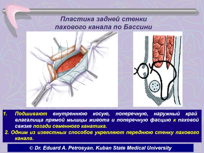 Способ кукуджанова при паховых грыжах схема - 80 фото