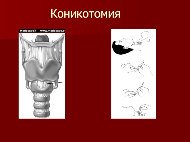 Трахеостомия у взрослых. Трахеостомия и коникотомия. Коникотомия анатомические ориентиры. Пункционная трахеостомия техника.