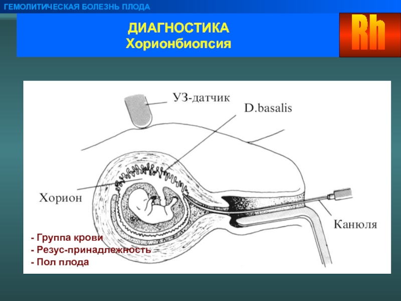 Диагностика плода. Гемолитическая болезнь плода. Гемолитическая болезнь Акушерство. Наиболее неблагоприятный признак гемолитической болезни плода:.