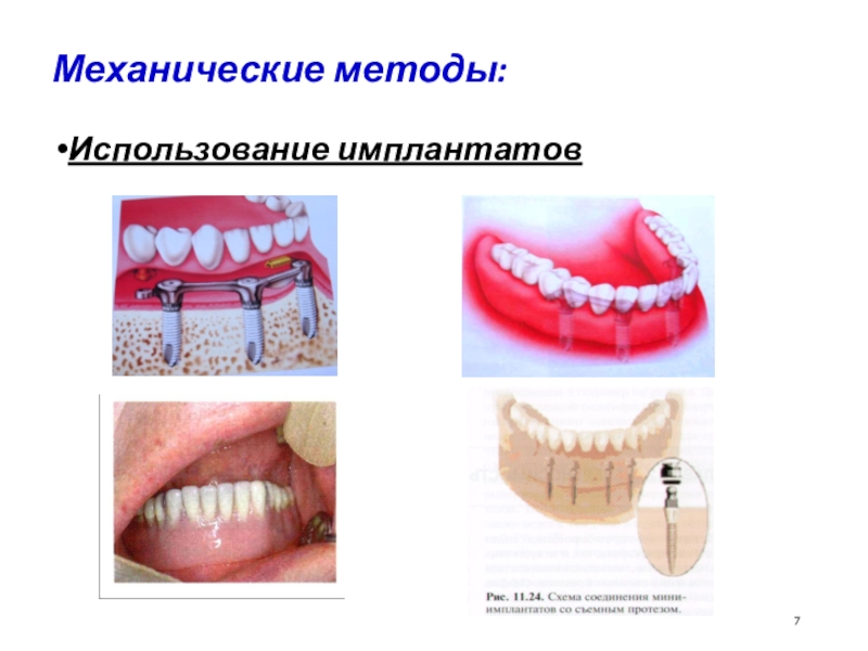 Механический метод. Пружины для фиксации полных съемных протезов. Механические методы.