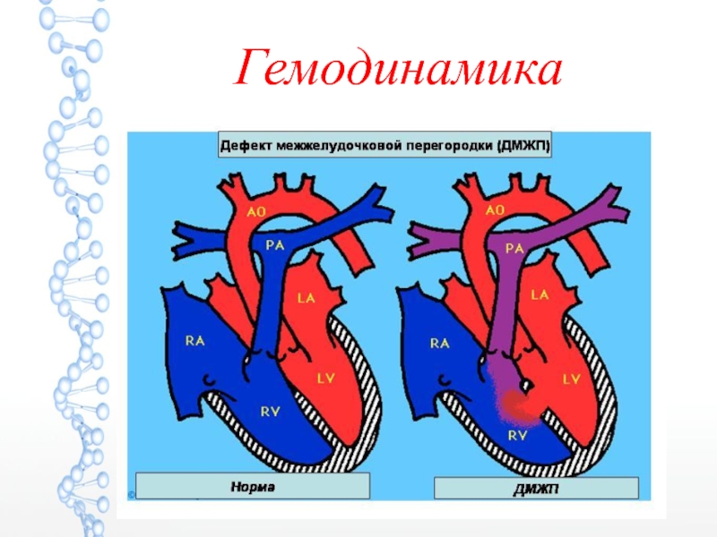 Дефект межжелудочковой перегородки гемодинамика схема