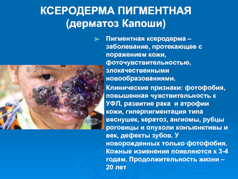 КСЕРОДЕРМА ПИГМЕНТНАЯ     (дерматоз Капоши)Пигментная ксеродерма – заболевание, протекающее с поражением кожи, фоточувствительностью, злокачественными