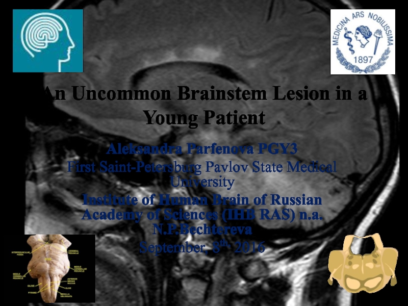 An Uncommon Brainstem Lesion in a Young Patient