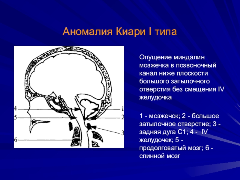 Картина аномалии арнольда киари 1 типа у взрослых