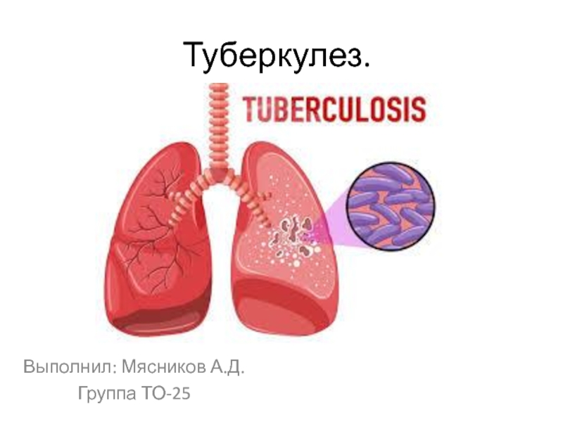Презентация Туберкулез