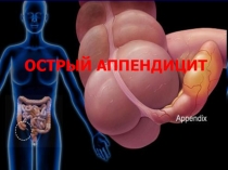 ОСТРЫЙ АППЕНДИЦИТ