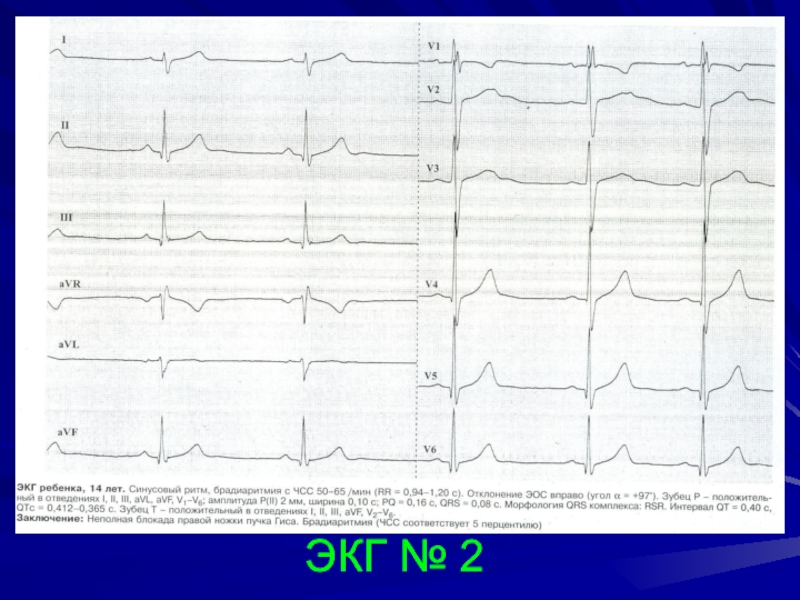Брадиаритмия у ребенка. Синдром гребешка на ЭКГ. ЭКГ гребешок. Симптом гребешка на ЭКГ. Синдром гребешка на ЭКГ У ребенка.