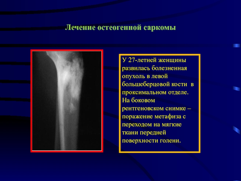 Опухоли костей презентация