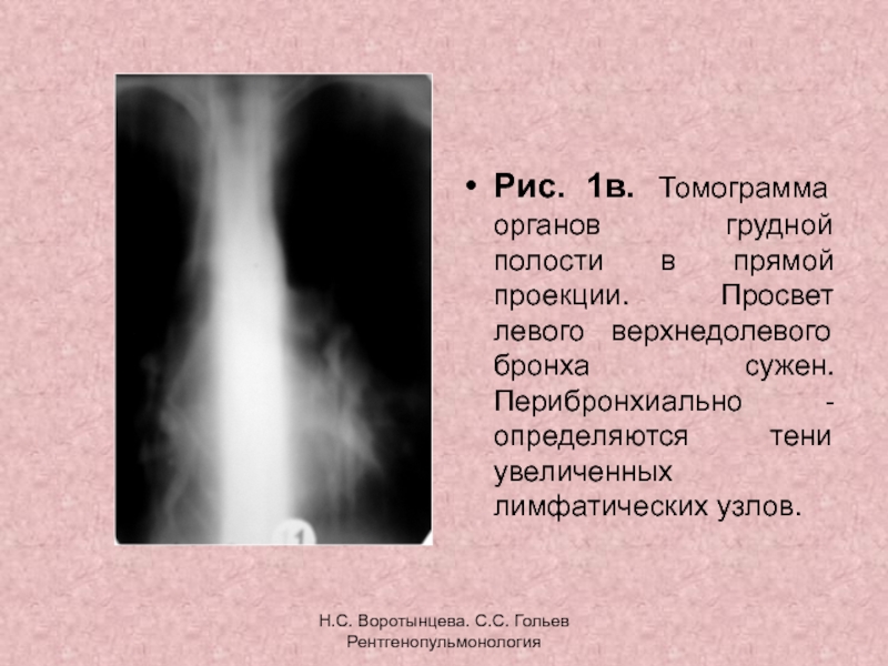 Расширить просвет бронхов