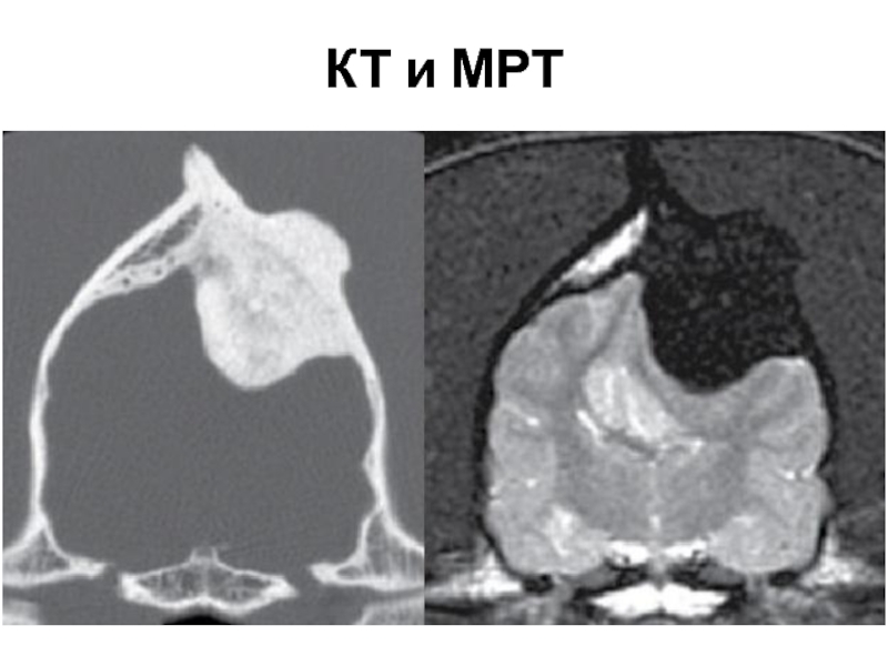 Кт в неврологии презентация