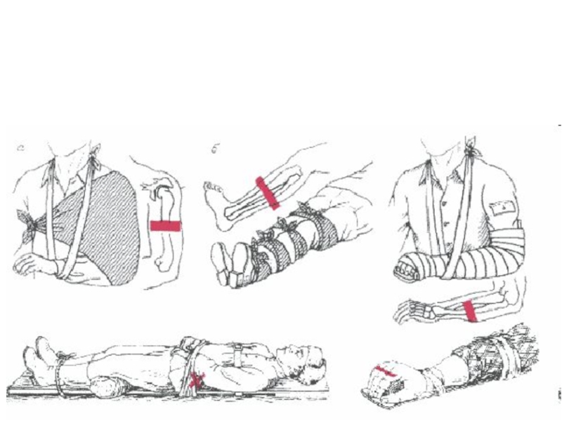 Оказание медицинской помощи при переломах. При оказании первой медицинской помощи при переломе. Перелом и оказание первой медицинской помощи при переломе..