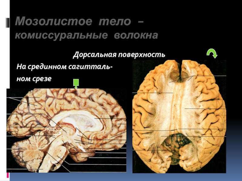 Мозолистое тело картинка