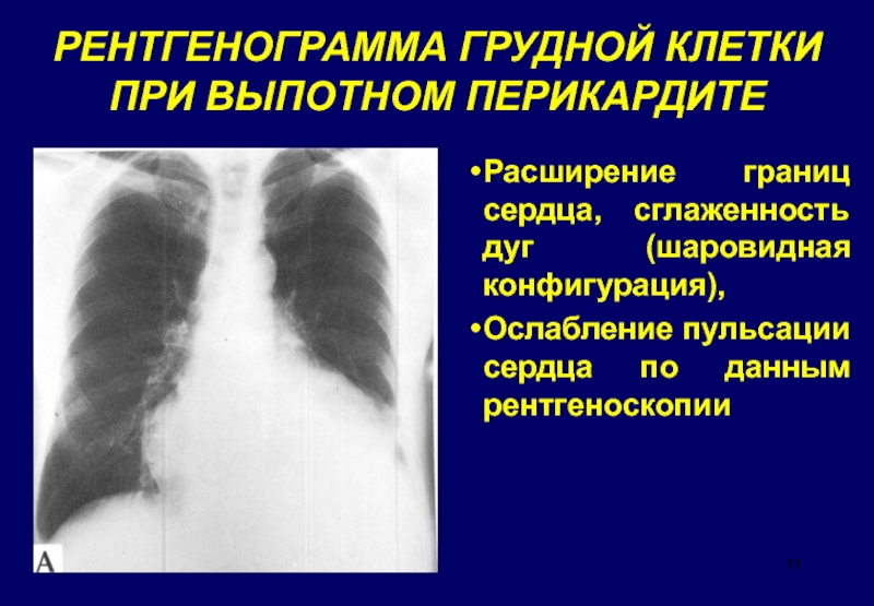 При выпотном перикардите на рентгенограмме наблюдается легочный рисунок тест ответ