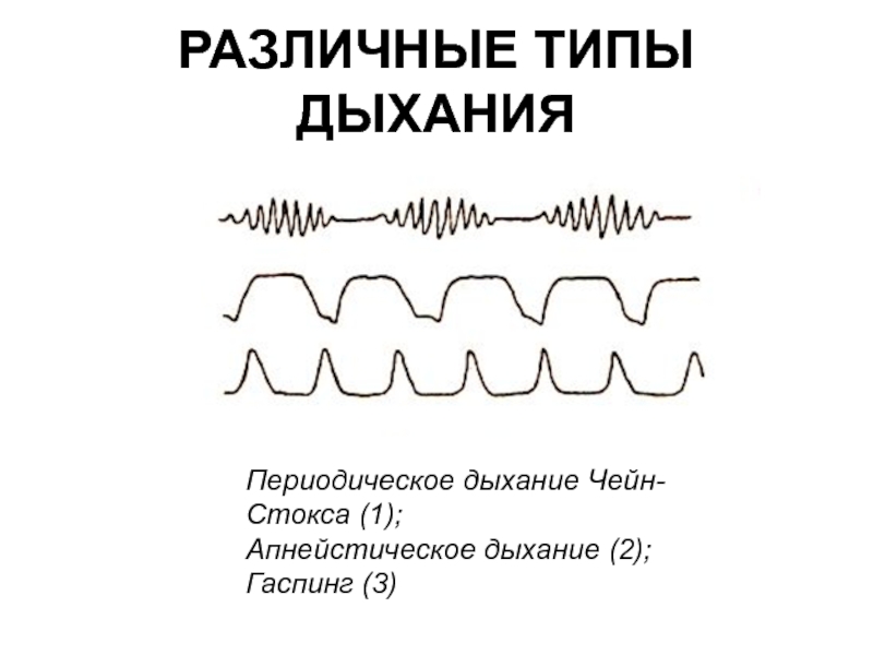 Апнейстическое дыхание рисунок