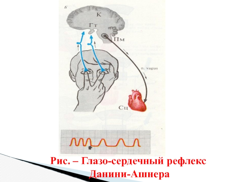 Схема рефлекторной дуги глазосердечного рефлекса