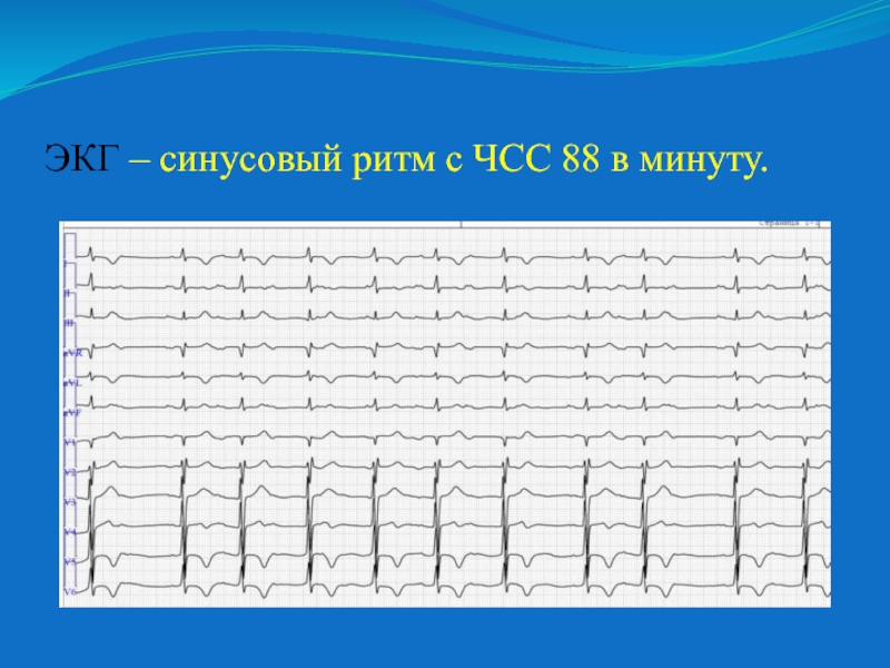 Синусовый ритм эос. Электрокардиограмма показатели синусовый ритм. ЭКГ оценка ритма синусового. Ритм синусовый с ЧСС. ЭКГ ритм синусовый ЧСС 676.