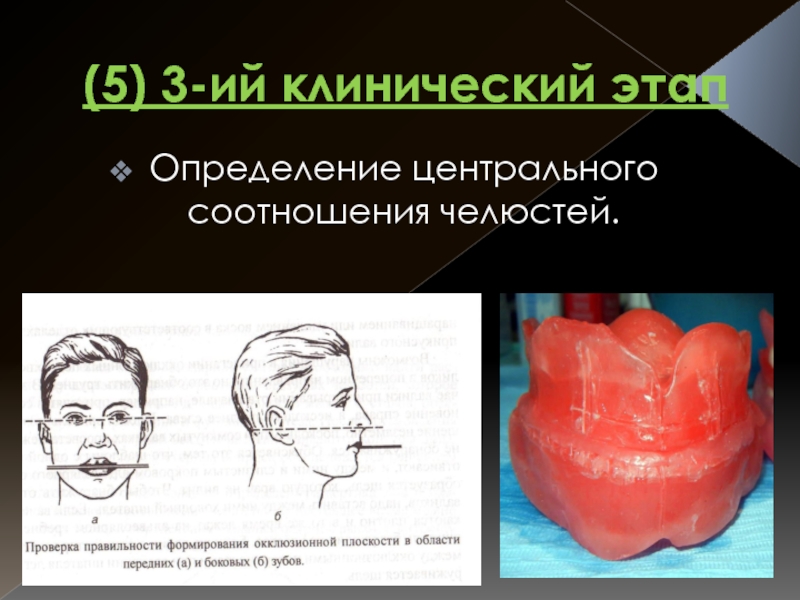 Методы определения центрального соотношения челюстей презентация