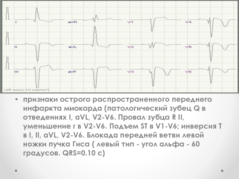 Карта вызова острый инфаркт миокарда с подъемом ст