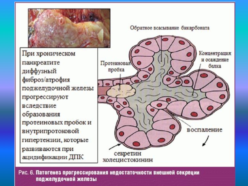 Атрофия поджелудочной железы. Макропрепарат при хроническом панкреатите. Хронический панкреатит гистология. Патогенез поджелудочной железы. Этиология нарушения внешнесекреторной функции поджелудочной.