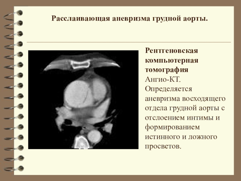 Расслаивающаяся аневризма аорты презентация