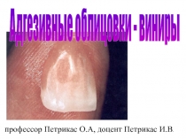 Протезирование дефектов коронок зубов винирами 