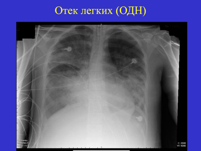 Рентгенологическая картина отека легких