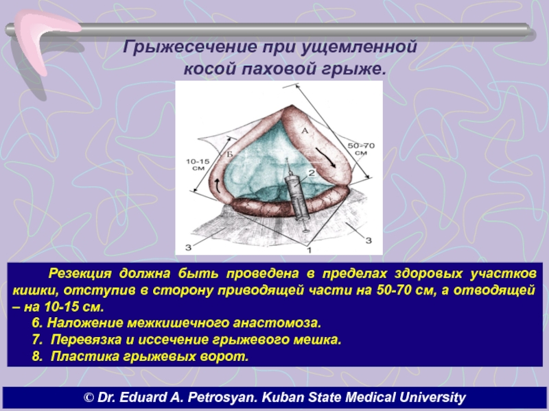 Ущемленная грыжа карта вызова