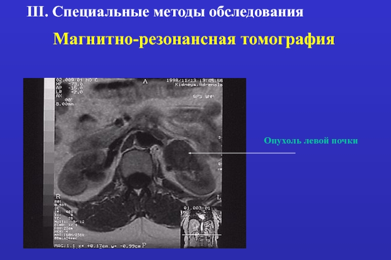 Объемное образование левой