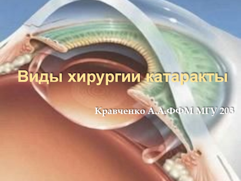 Виды хирургии катаракты