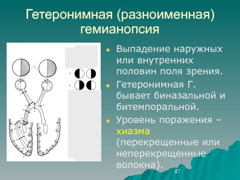 У больного имеется повреждение левого зрительного нерва нарисуйте картину изменения полей зрения