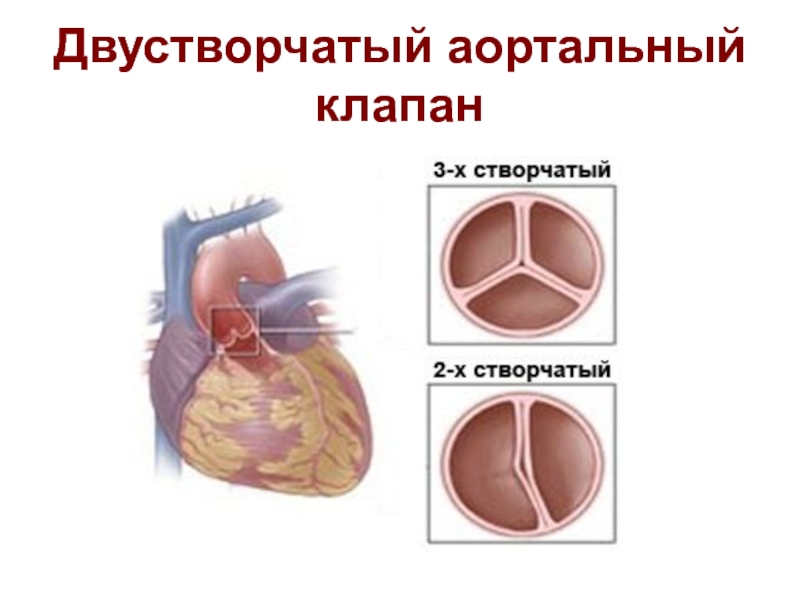 Аортальный клапан сердца. Двухстворчатый аортальный клапан. Клапан сердца порок двухстворчатый аортальный клапан. 2х створчатый аортальный клапан у детей. 2х створчатый клапан сердца.