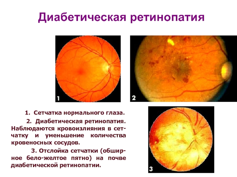 День сетчатки. Диабетическая ретинопатия глазное дно. Пролиферативная диабетическая ретинопатия. Ангиопатия и ретинопатия сетчатки. Пролиферативная диабетическая ретинопатия глазное дно.