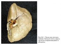Рис.54.1. Почка при септико-
пиемии. Капсула снята, видны
частично
