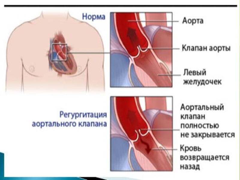 Митральная регургитация 1 2 степени