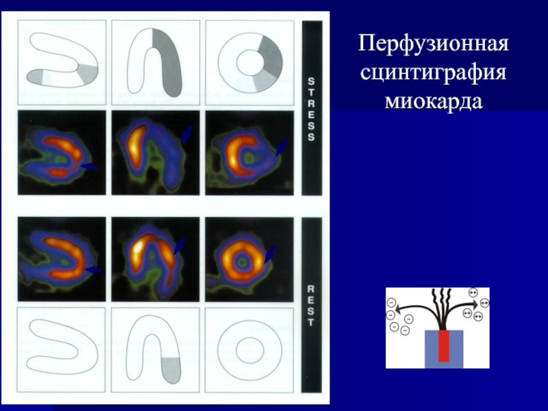 Презентация сцинтиграфия миокарда