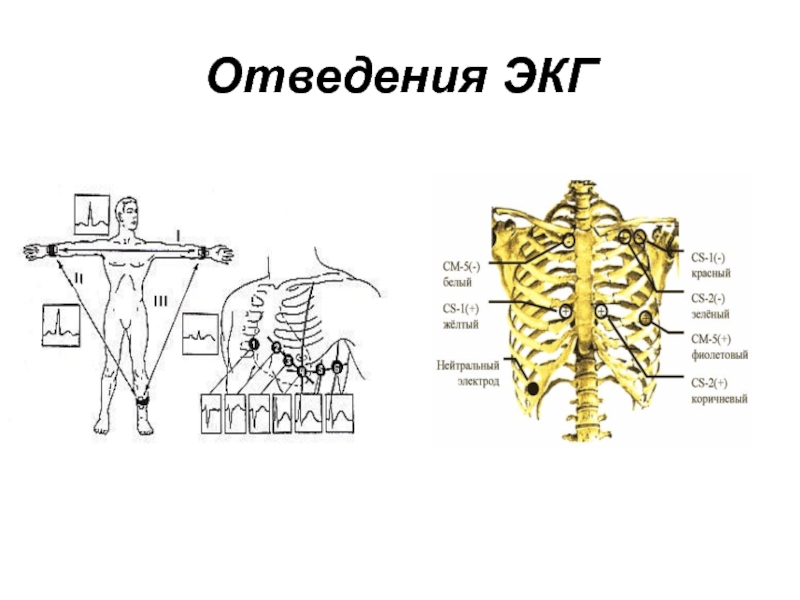 Экг отведения картинка