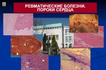 Ревматические болезни. пороки сердца