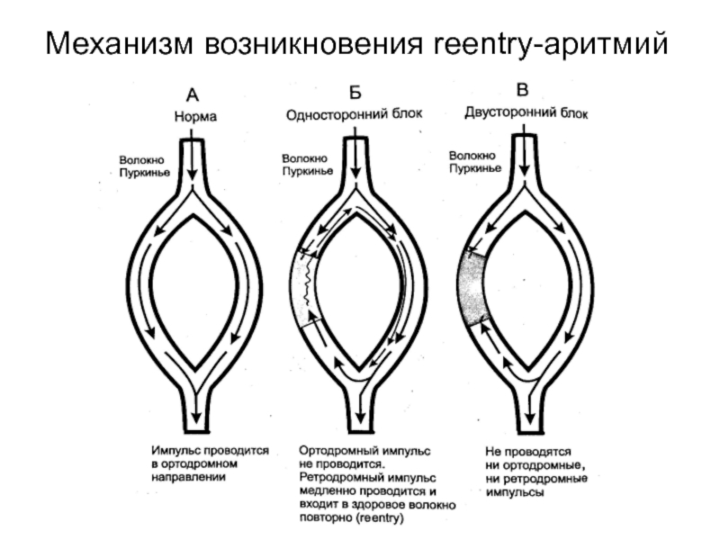 Блок схема аритмии