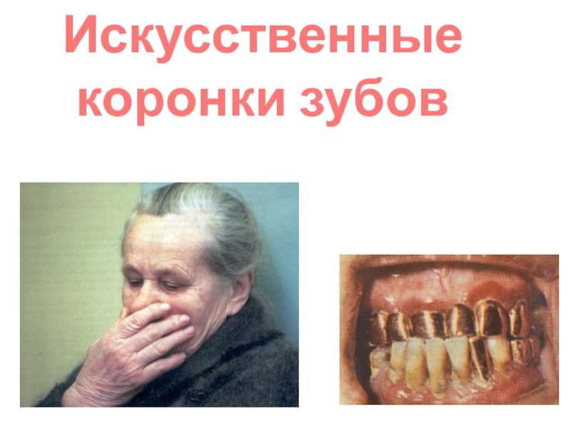 Презентация Искусственные коронки зубов 