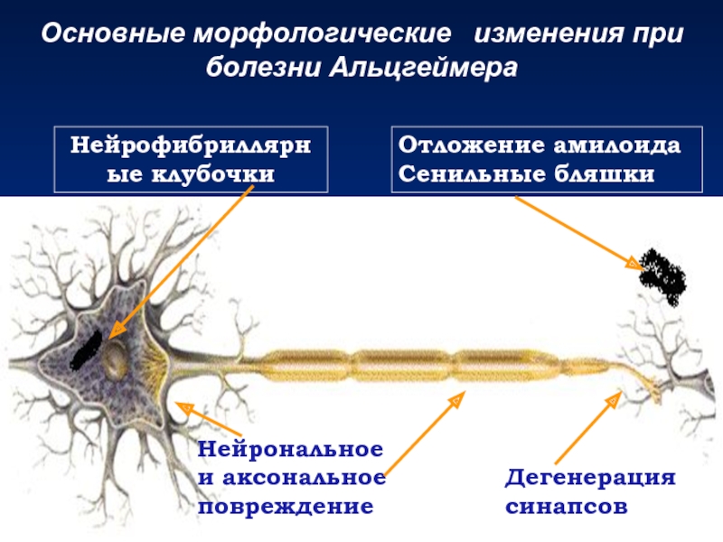 Аксональная полинейропатия нижних. Аксонально-демиелинизирующая нейропатия. Аксональные и Демиелинизирующие полинейропатии. Аксональное поражение нерва что это. Морфологические изменения при болезни Альцгеймера.