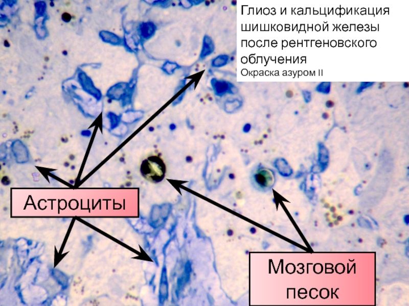 Глиоз это. Глиоз головного мозга гистология. Астроцитарный глиоз гистология. Кальцификация шишковидной железы.