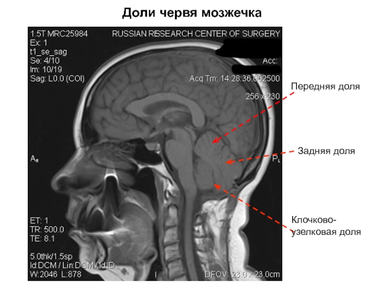 Доли червя мозжечка
Передняя доля
Задняя доля
Клочково -узелковая доля