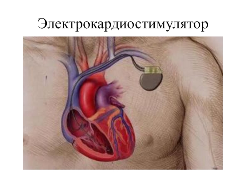 Доклад: Электрокардиостимуляторы