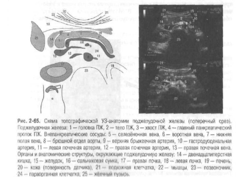 Норма узи поджелудочной железы у мужчин. Ультразвуковая анатомия поджелудочной железы. Кт анатомия поджелудочной железы. Аберрантная поджелудочная железа рентген. Аберрантный проток поджелудочной железы мрт.