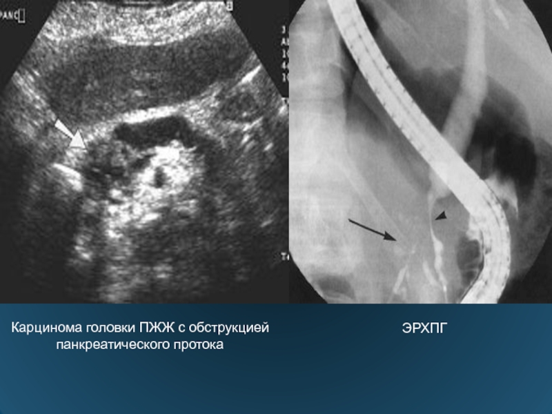 Узи поджелудочной форум. Обструкция панкреатического протока.