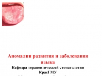 Аномалии развития и заболевания языка.ppt