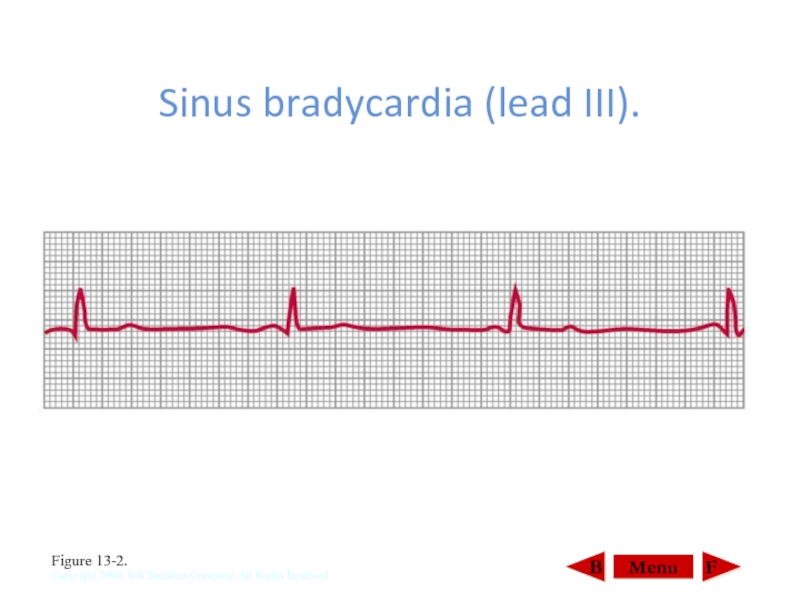 Lead 3. Sinus bradycardia. Синус брадикардия. Брадикардия у кошек.